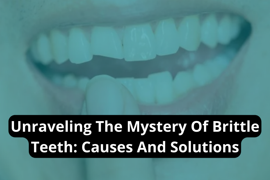 Close-up of teeth with guide on brittle teeth causes and solutions at Great Oaks Dentistry in New Braunfels